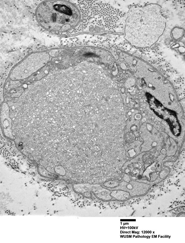 16C8 (Case 16) L PIN nerve_033 - Copy