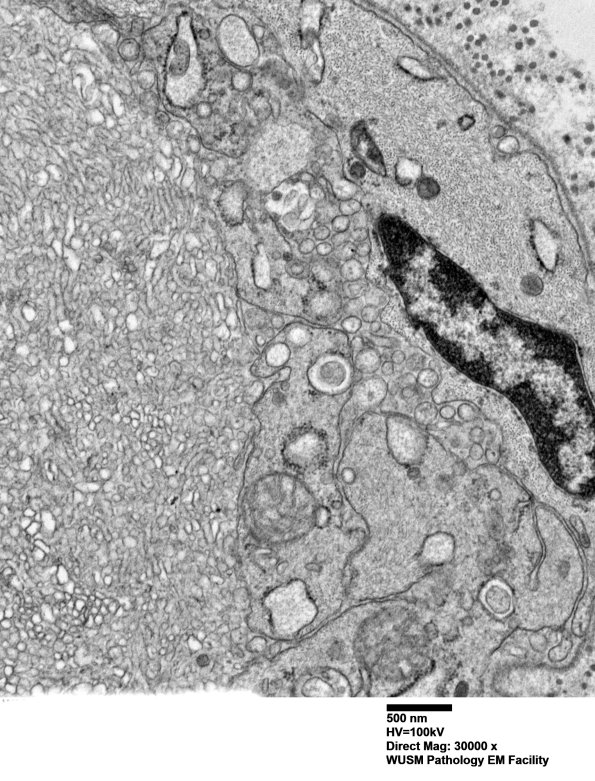 16C9 (Case 16) L PIN nerve_038 - Copy