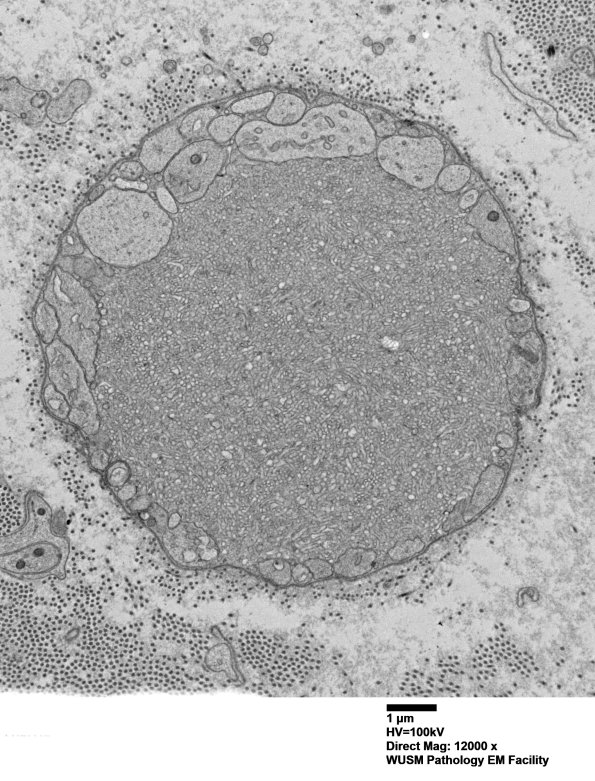 16C9 (Case 16) L PIN nerve_069 - Copy
