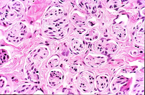 17A2 Neuroma, traumatic (Case 17) H&E 2