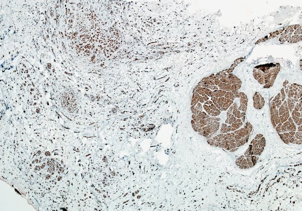 17B1 Neuroma, traumatic (Case 17) NF 3