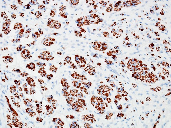 17B2 Neuroma, traumatic (Case 17) NF 2