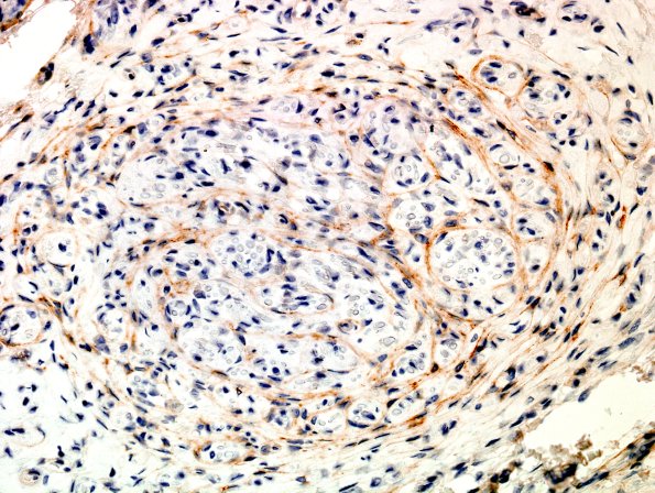 17C1 Neuroma, traumatic (Case 17) EMA 1