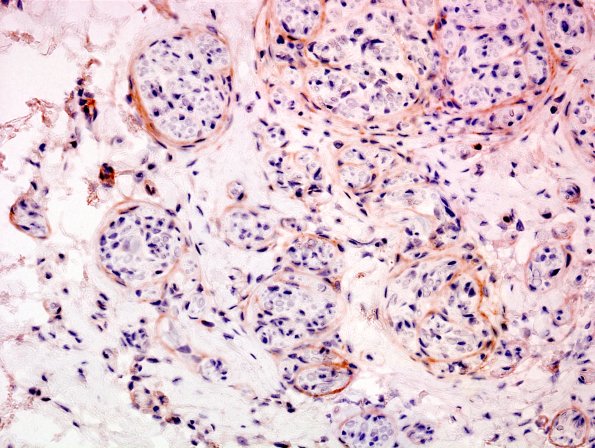 17C2 Neuroma 4i (Case 17) EMA  1