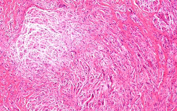 18A0 Neuroma (Case 18) H&E 10X