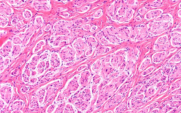 18A0 Neuroma (Case 18) H&E 20X