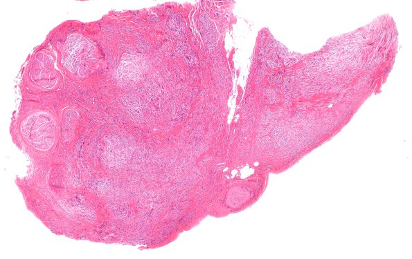 18A0 Neuroma (Case 18) H&E 2X
