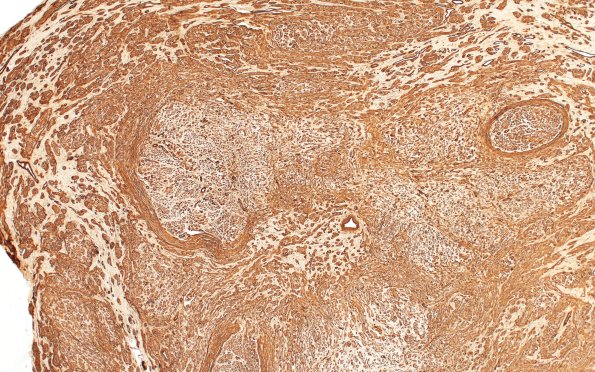 18A1 Neuroma (Case 18) Coll IV 4X