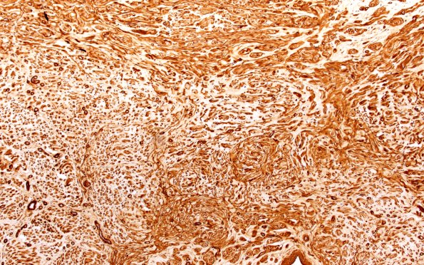 18A2 Neuroma (Case 18) Coll IV 10X