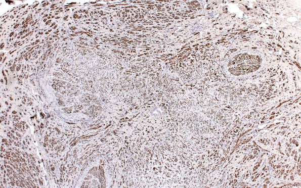 18B1 Neuroma (Case 18) NF 4X