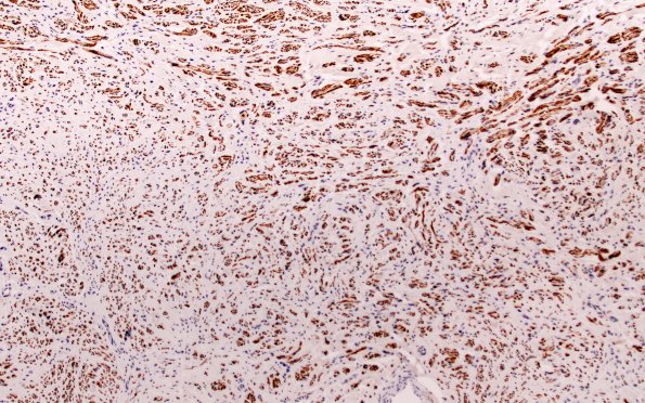 18B2 Neuroma (Case 18) NF 10X