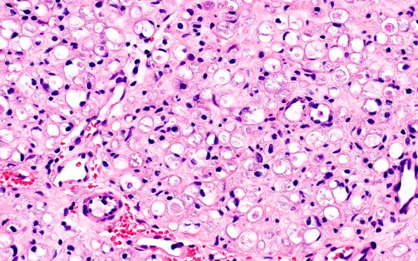 19A2 Trauma (Case 19) Proximal S1 root H&E Slide B1 40X