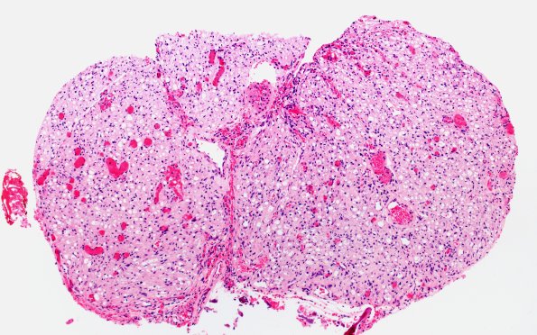 19A3 Trauma (Case 19) Distal S1 root H&E Slide A1 10X 1