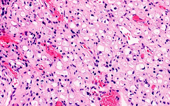 19A4 Trauma (Case 19) Distal S1 root H&E Slide A1 40X 1