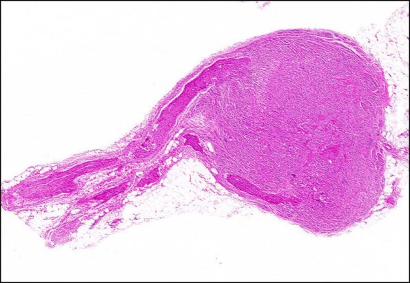 1A1 Neuroma, traumatic (Case 1) H&E 2X