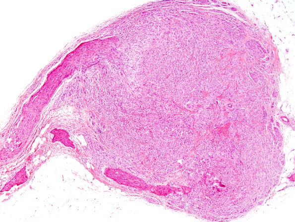 1A2 Neuroma, traumatic (Case 1) H&E 1A