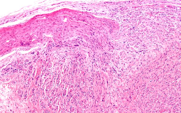 1A3 Neuroma, traumatic (Case 1) H&E 10X