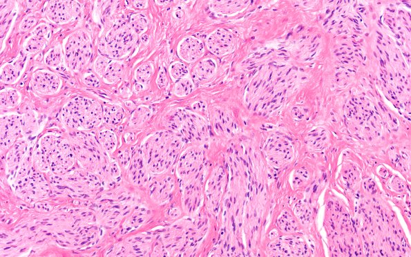 1A4 Neuroma, traumatic (Case 1) H&E 20X 2