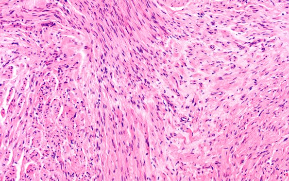 1A5 Neuroma, traumatic (Case 1) H&E 20X