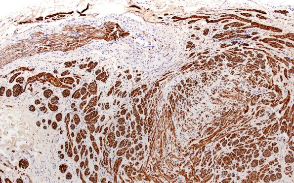 1B2 Neuroma, traumatic (Case 1) NF 10X