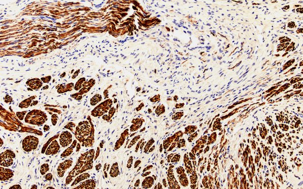 1B3 Neuroma, traumatic (Case 1) NF 20X