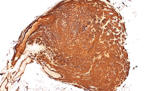 1C1 Neuroma, traumatic (Case 1) Coll IV 4X