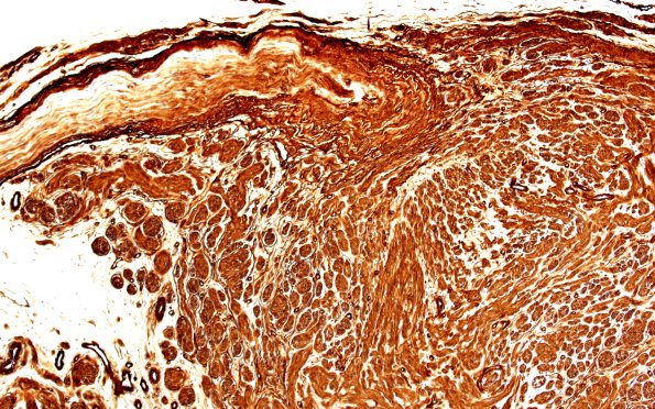 1C2 Neuroma, traumatic (Case 1) CollIV 10X
