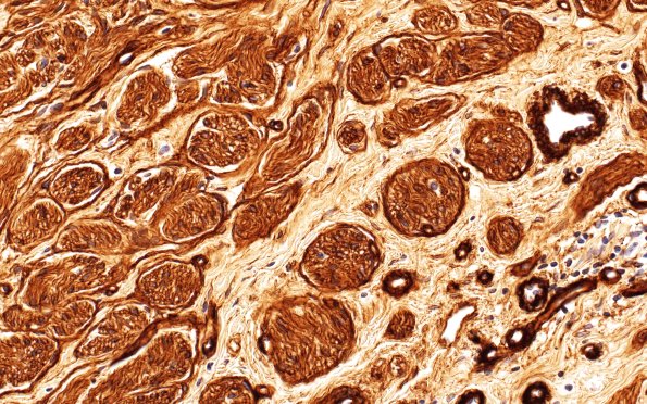 1C4 Neuroma, traumatic (Case 1) Coll IV 40X