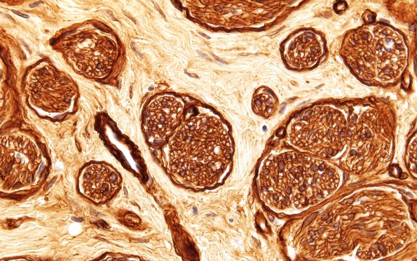 1C5 Neuroma (Case 1) 100X EMA 5