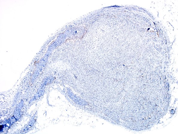 1D1 Neuroma (Case 1) EMA 2X