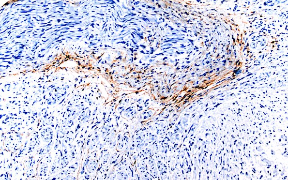 1D2 Neuroma, traumatic (Case 1) EMA 20X