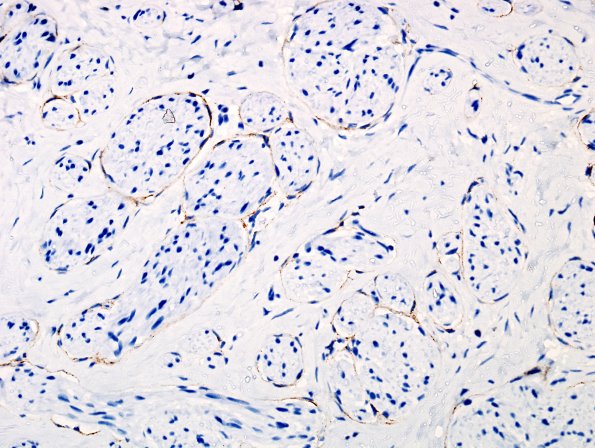 1D3 Neuroma (Case 1) EMA 1