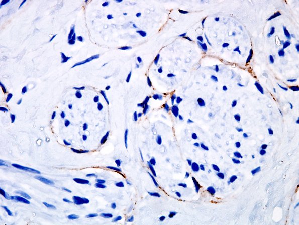 1D4 Neuroma (Case 1) 100X EMA 2