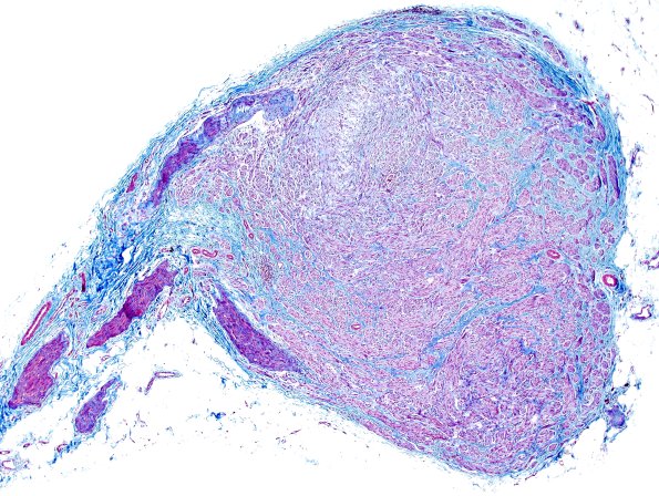 1E1 Neuroma, traumatic (Case 1) Trichrome-1