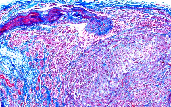 1E2 Neuroma, traumatic (Case 1) TRI 10X