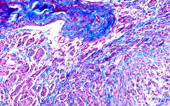 1E3 Neuroma, traumatic (Case 1) TRI 20X