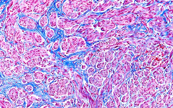 1E4 Neuroma, traumatic (Case 1 TRI 20X 2