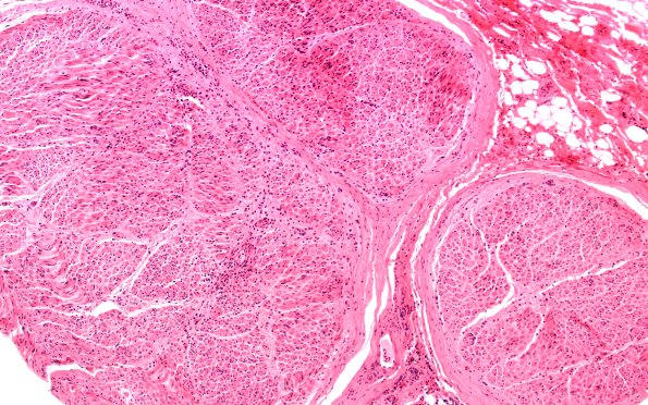 20A1 Suprascapular nerve (Case 20) H&EBlkB 10X