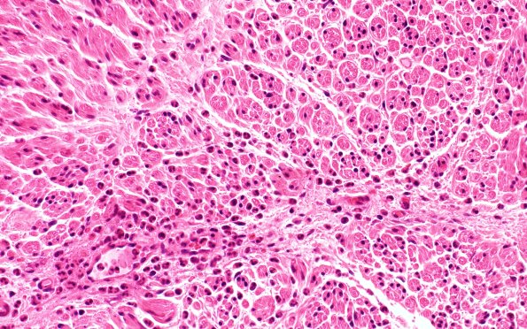 20A2 Suprascapular nerve (Case 20) H&EBlkB 40X 2