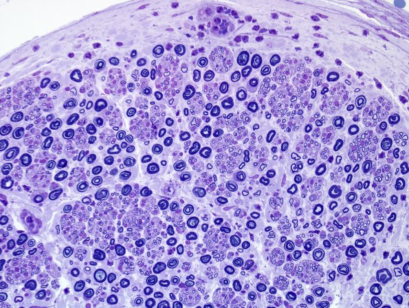 20B1 Suprascapular nerve (Case 20) Plastic B-1 40X 1.jpg