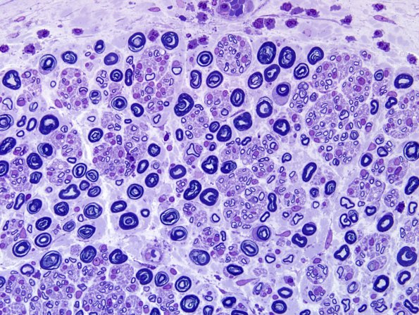 20B2 Suprascapular nerve (Case 20) Plastic B-1 60X.jpg