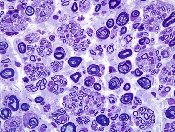 20B4 Suprascapular nerve (Case 20) Plastic B-1 100X 16.jpg