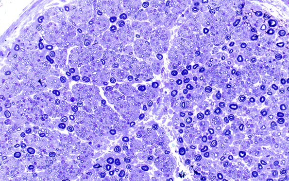 20C1 Suprascapular nerve (Case 20) Plastic B-2 40X 1