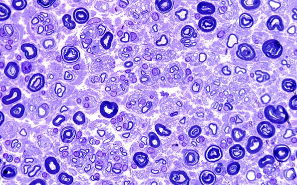 20C2 Suprascapular nerve (Case 20) Plastic B-2 100X 1