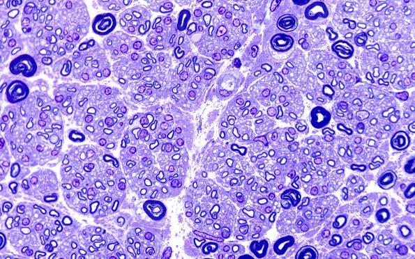 20C3 Suprascapular nerve (Case 20) Plastic B-2 100X 2