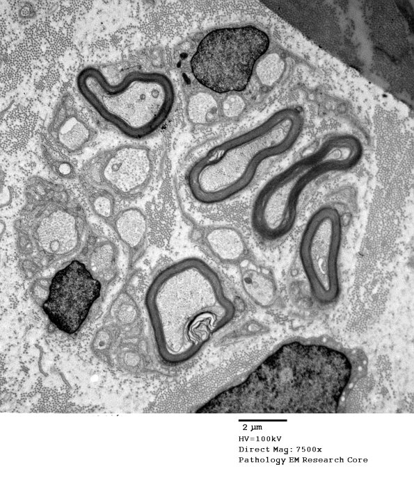 20D1 Suprascapular nerve (Case 20 EM 009A - Copy