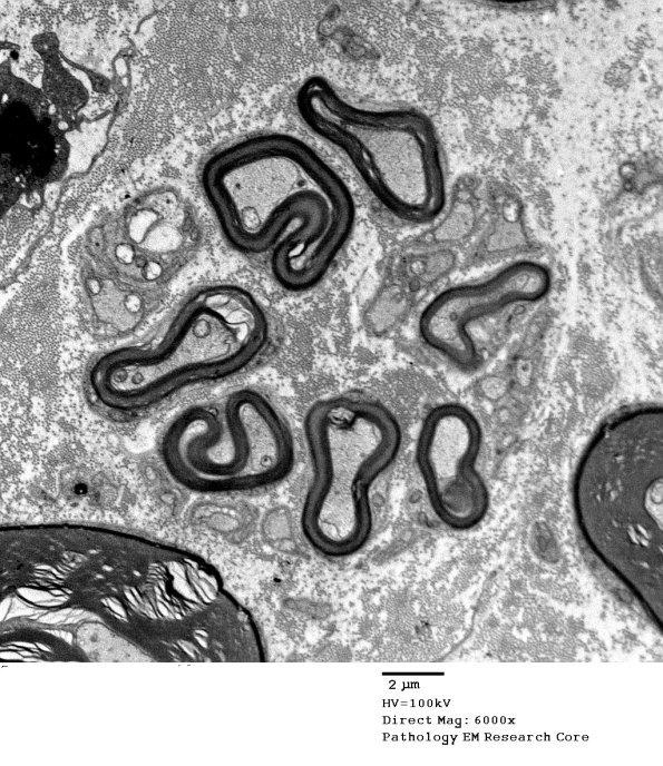 20D2 Suprascapular nerve (Case 20) EM 016A - Copy
