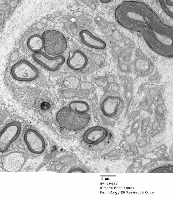 20D3 Suprascapular nerve (Case 20) EM 038A - Copy