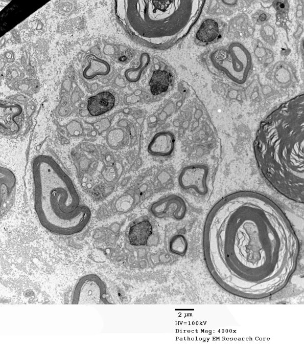 20D4 Suprascapular nerve (Case 20) EM 079A - Copy