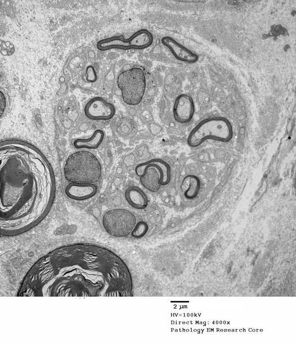 20D5 Suprascapular nerve (Case 20) EM 085A - Copy